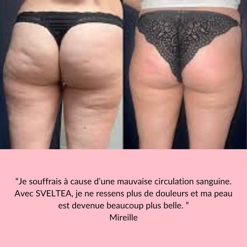 Sublimez Votre Peau Naturellement et Efficacement avec SVELTEA